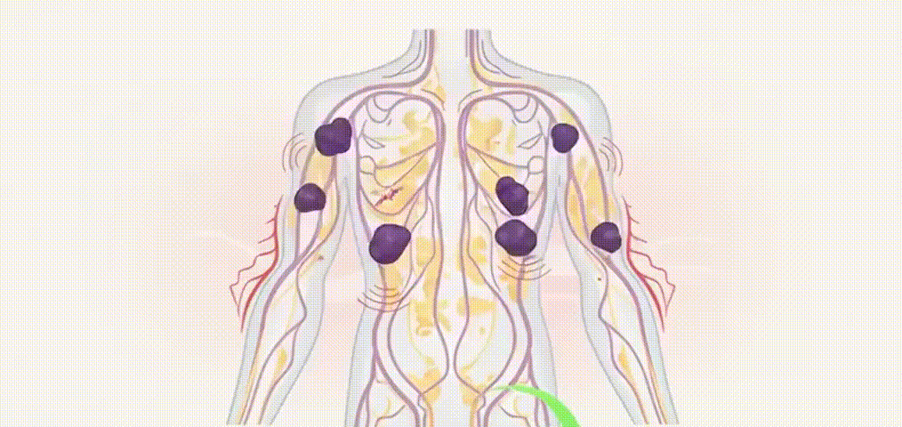 Lymphatic flow illustration